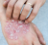 Psoriasis