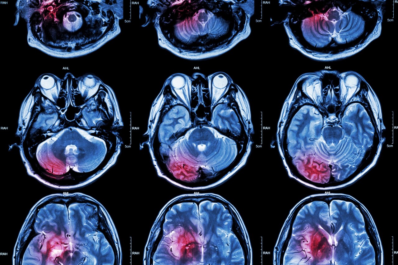 Neurologie